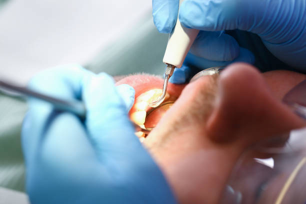 Best Emergency Wisdom Tooth Extraction in Villa Park, CA