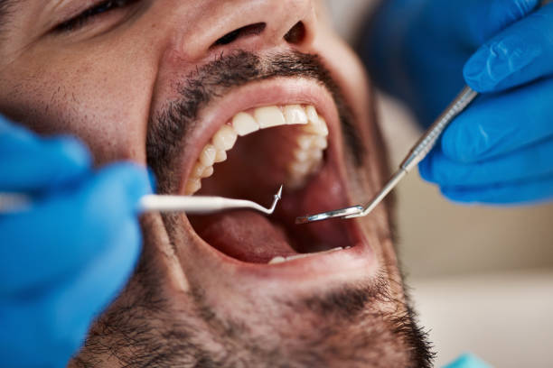 Best Knocked-Out Tooth (Avulsed Tooth) Treatment in Villa Park, CA